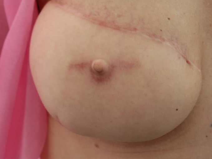 2 mikropigmentacja brodawki piersi rak piersi kobieta uroda